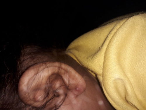 Lubang ating telinga