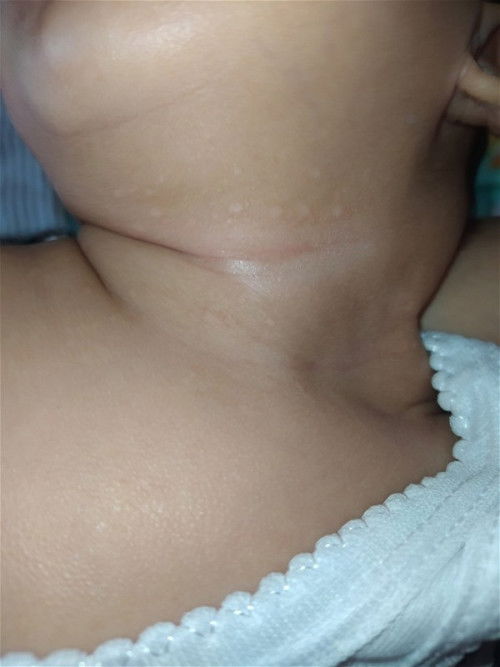 Bercak putih sekitar leher