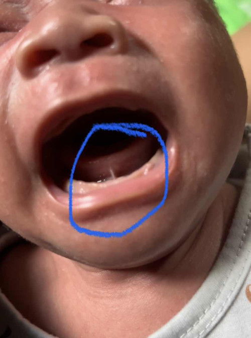 Tongue tie