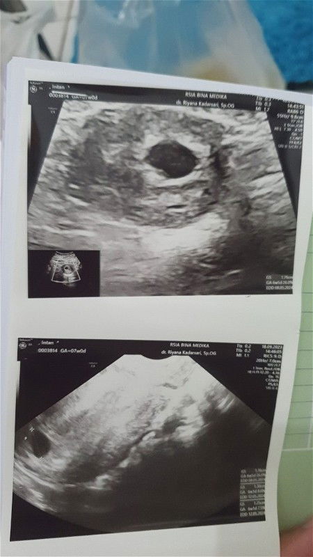 Hamil 6week 5hari baru terlihat kantung janin