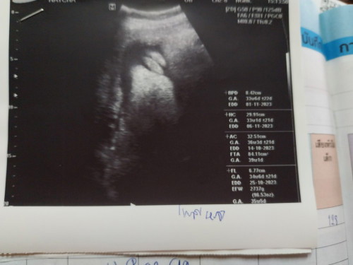 ผลอัลตราซาวด์แบบนี้ชัวร์เพศ100%ไหมคะ