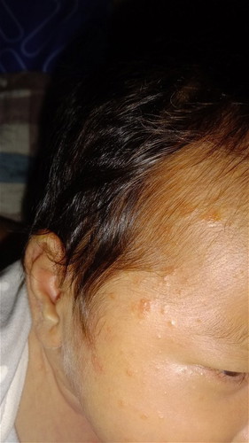 Rashes po ba ito?