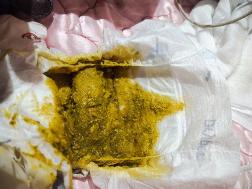 Najis baby 1m3d jadi warna kuning bercampur hijau. Normal ka