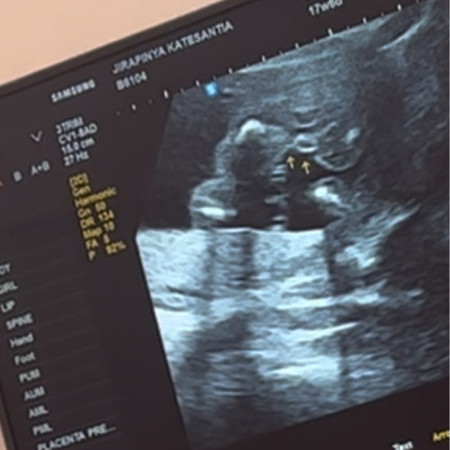 ญ รึ ช ค่ะ ท้องแรก 18 w