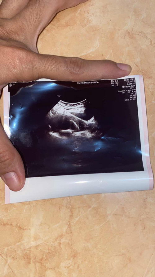 Habis keguguran tanpa kuret