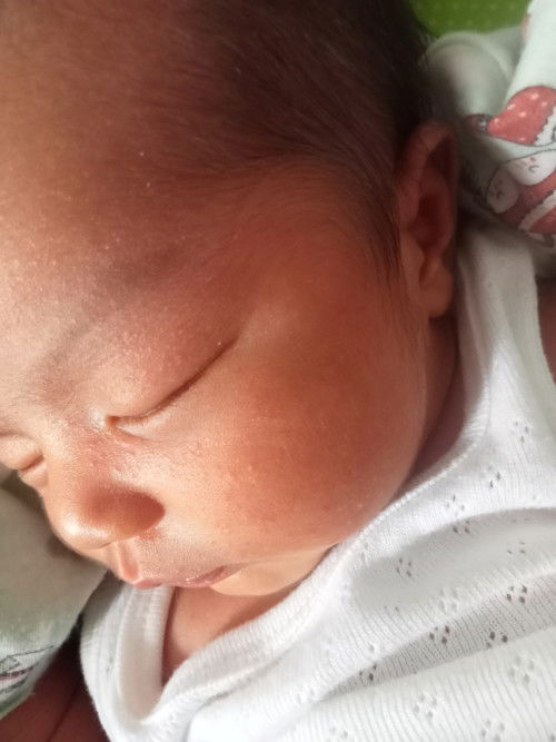 เป็นผื่นหรือผด