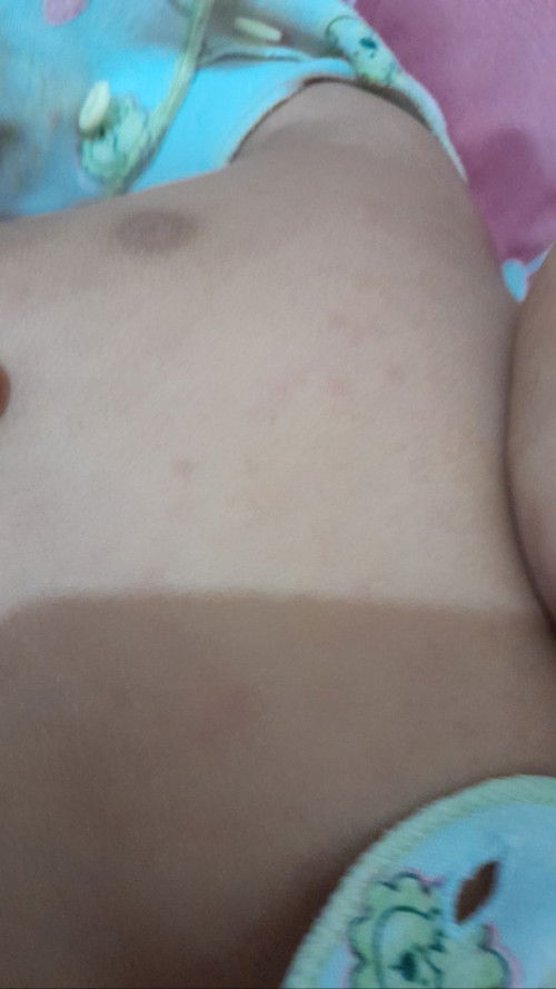 Bayi 6 bulan demam 3hari