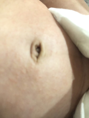 น้อง1เดือน20 วันสะดือเป็นแบบนี้