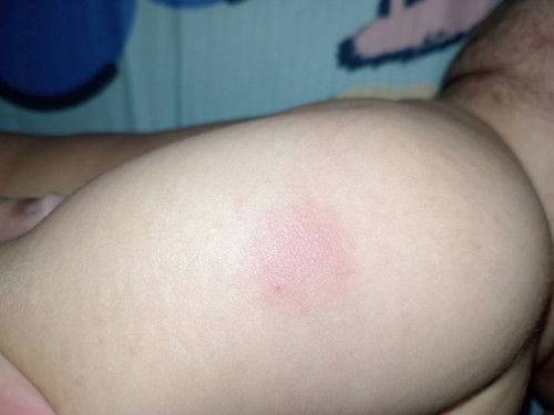 Lebam lepas injection