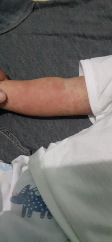 Nagka rashes si baby