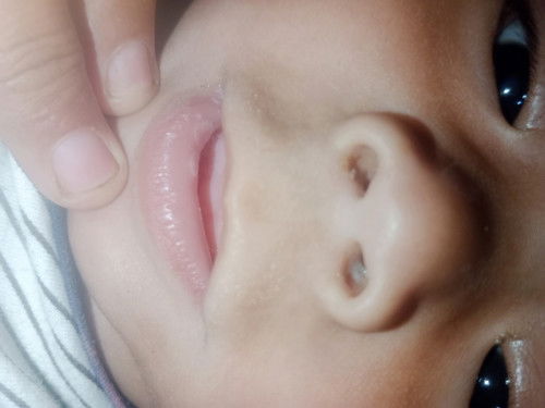 Bayi 6 bulan sariawan