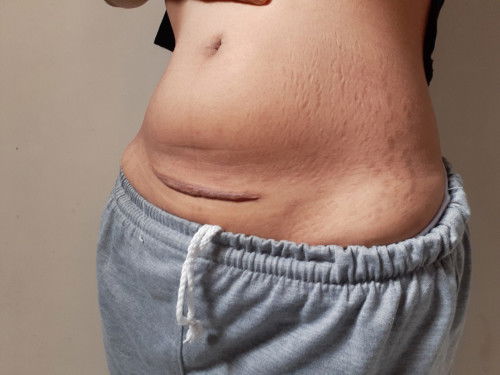 Pengen bgt bisa balikin kondisi perut