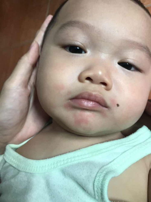 แพ้นมวัว จะหายหรือดีขึ้นเมื่อไหร่คะ