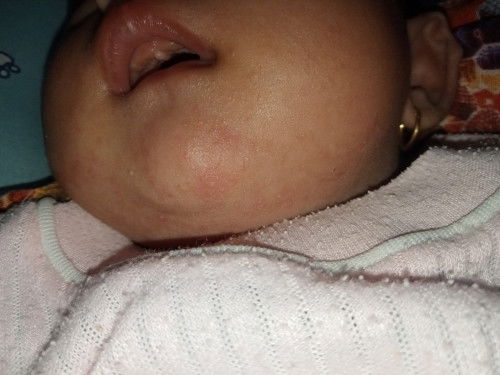 Benjolan putih digusi