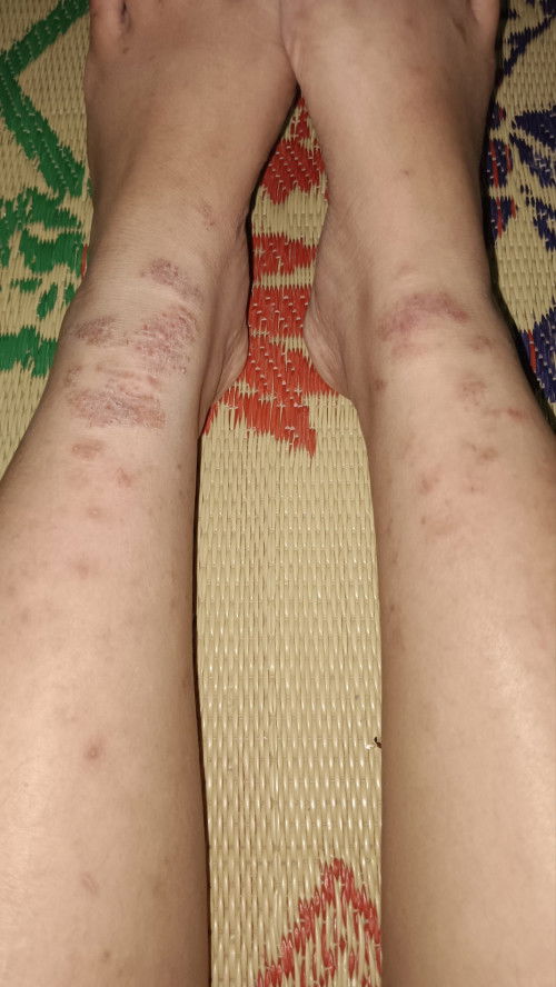 Ini cara ngilangin nya gmna ya, udh minum obat, salep ttep ga ilang. Abis lahiran apa bsa ilang bun?