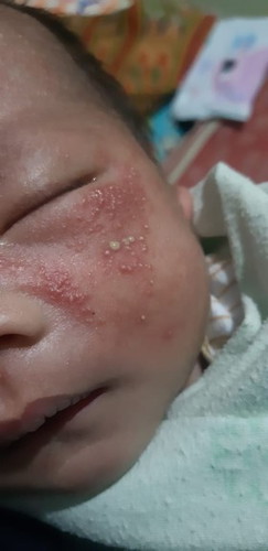 bayi ku baru 9 hari udah muncul bintik merah, tolong dong kasih tahu cara ngilangin nya