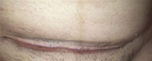 แผลผ่าแบบนี้ปกติมั้ยคะ