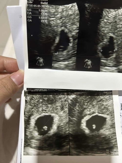 Hamil 8 minggu janin belum terlihat