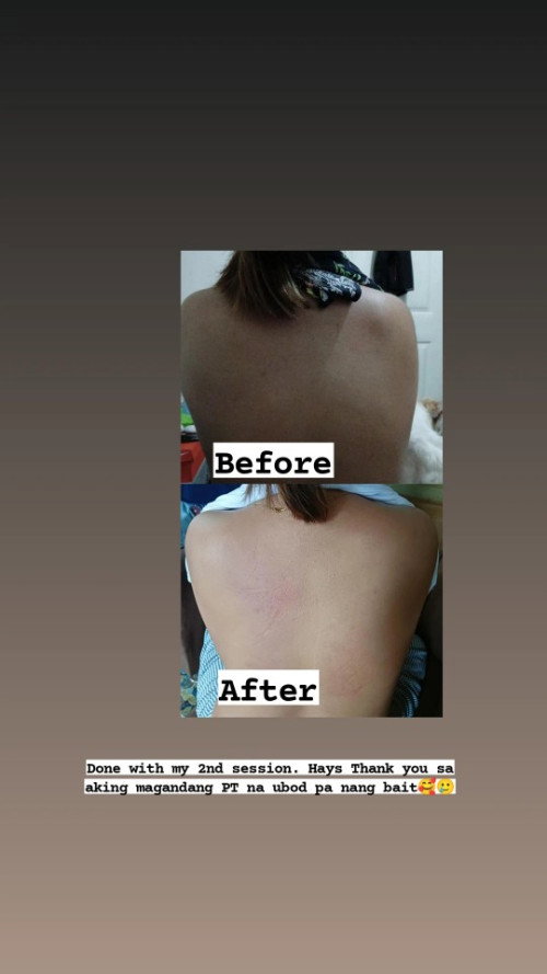 Sino dito nakakaranas nang pain sa buong likod? Umabot na sa hips ko to paa?