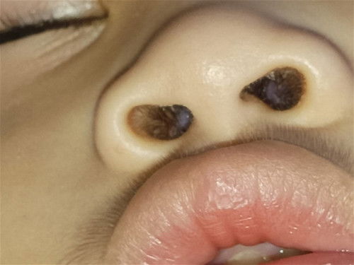 mga mi ung parang white na bilog po ba sa ilong ng toddler ko is sipon?