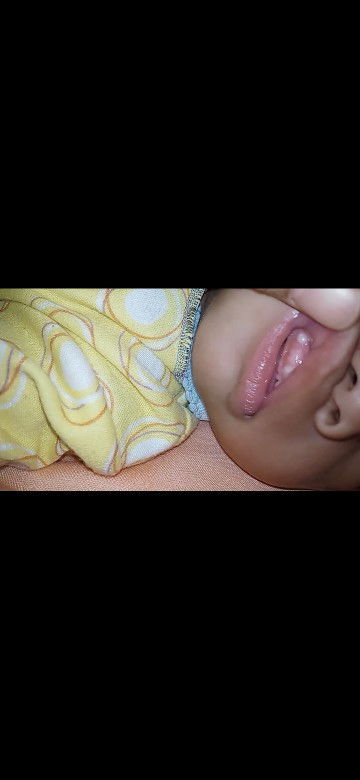 Putih-putih di gusi bayi