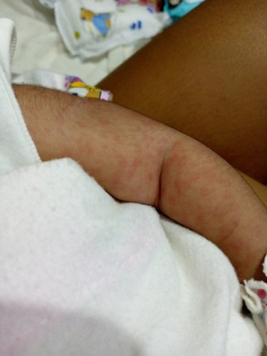 Baby red spots