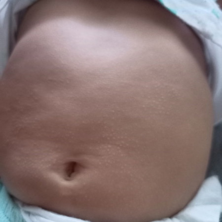 Maaf bertnya ,Kenapa ya ada tumbuh biji² ginie kat perut anak saya ? Anak baru 4 bulan, sy first mum