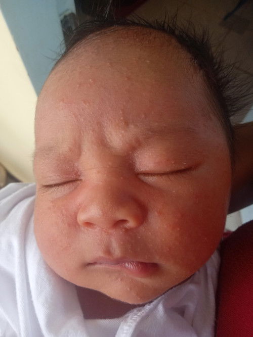 BABY ACNE......