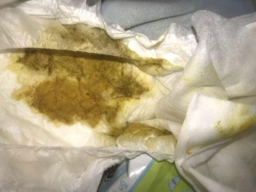 อุจาระทารกก