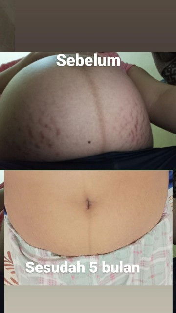 Halo bunda bunda mau share tentang memudar kan strecmack