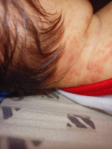 Rashes o allergy?