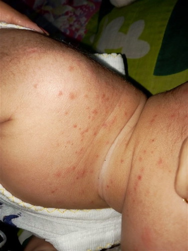 Ruam merah pada bayi