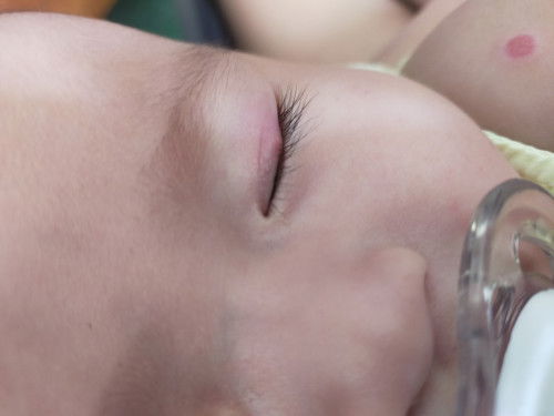 bé nhà e 3th19 ngày , mắt bé bị nổi vầy mng cho e hỏi là nổi gì và cách trị ạ