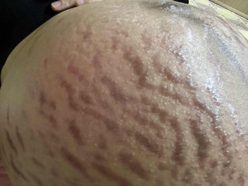 Em bị rạn mẩn ngứa hết lên giờ có gì bôi cho đỡ không các mom? Chứ em ngứa quá không chịu được