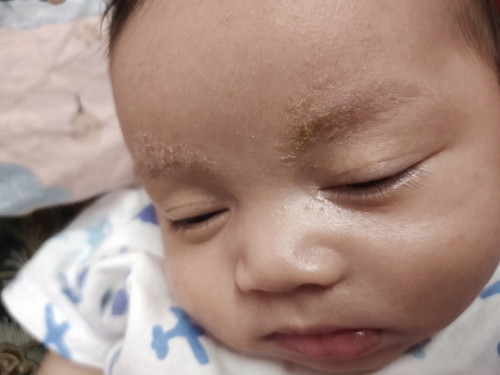 Ruam atau sakit lain?