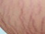 Strech mark