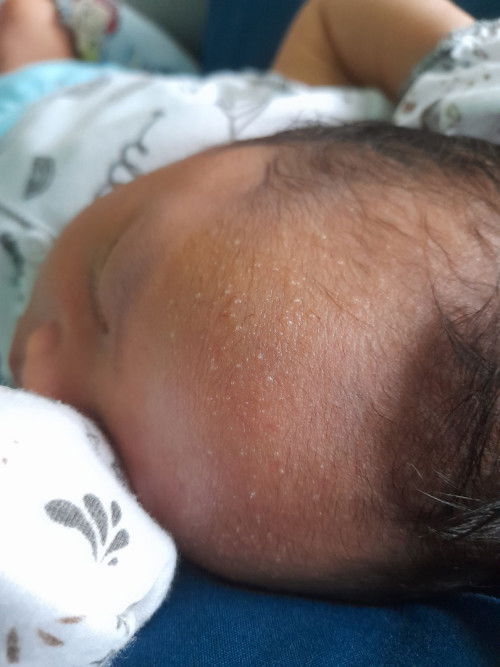 Beruntusan putih bayi 5hari