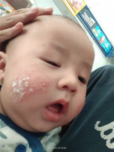 Obat ruam pipi bayi karena asi