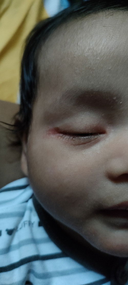 MATA MERAH BERAIR DAN BELEKAN