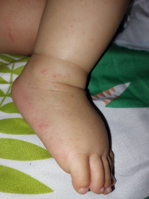 Chicken pox, HFMD, Measles