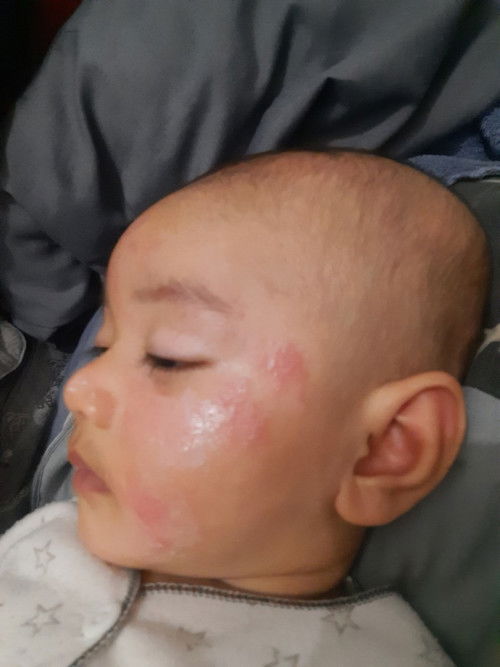 Obat untuk Ruam Seperti Biang Keringat