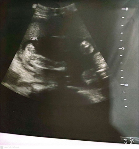 Ultrasound