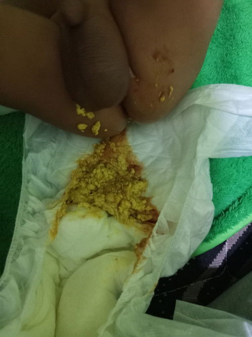 Mom, mau tanya dong bayi aku 2bulan 13hari kok pagi ini pup nya gini ya mom dan sering kembung perut