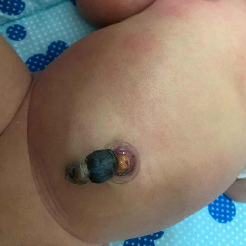 สะดือหลุดแบบนี่