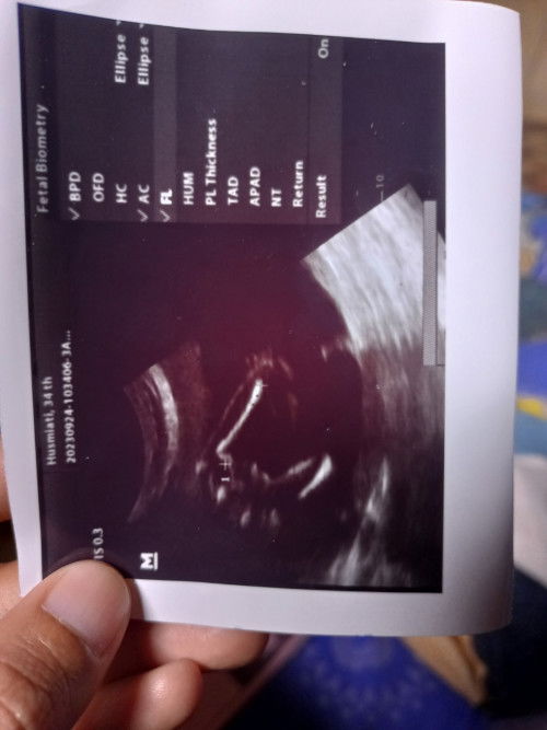 Jenis kelamin UK 21 Minggu 6 hari