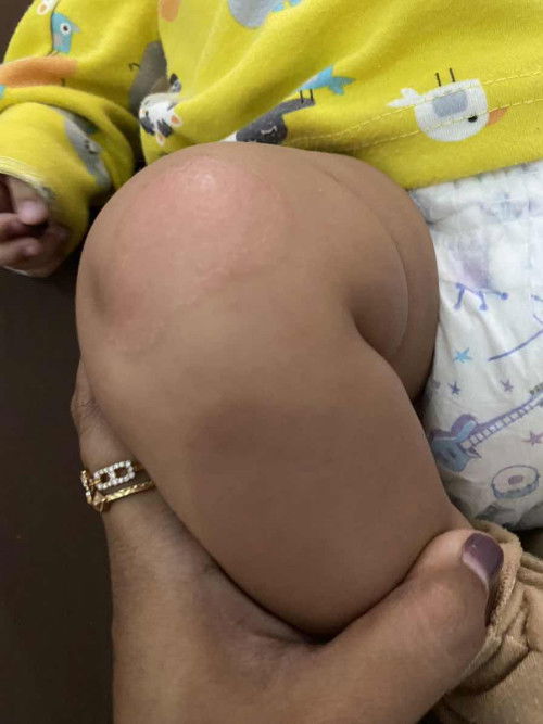 kemerahan dilutut bayi