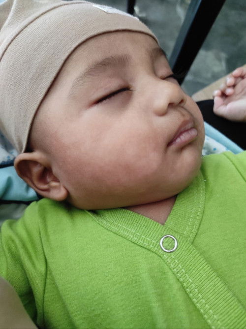 Bun ini muka anak saya ada bercak2 putih apakah ada yg pernah alamin? Ini apa ya???