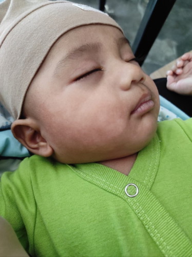 Bun ini muka anak saya ada bercak2 putih apakah ada yg pernah alamin? Ini apa ya???