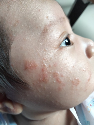 ผื่นขึ้นหน้า