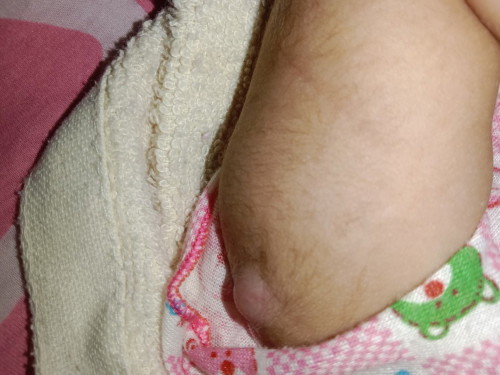 ลูกปลูกฝีได้สองเดือนแล้วแต่ยังไม่แตกแบบนี้อยู่ปกติมั้ยคะ?